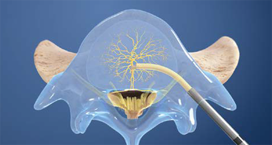 second rfa procedure illustration