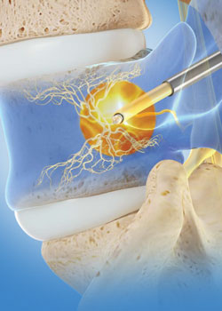 RFA procedure illustration