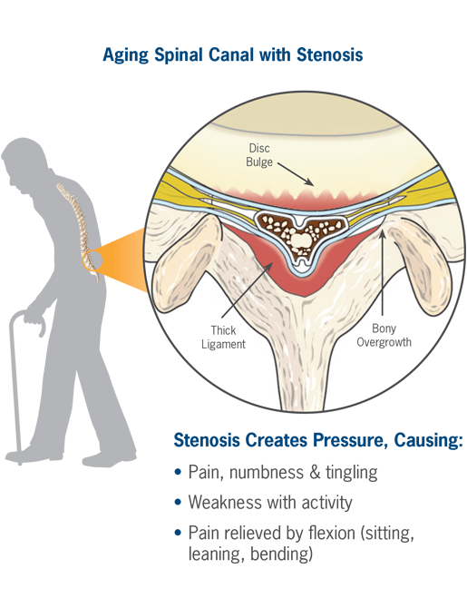 Aging spinal with stenosis illustration