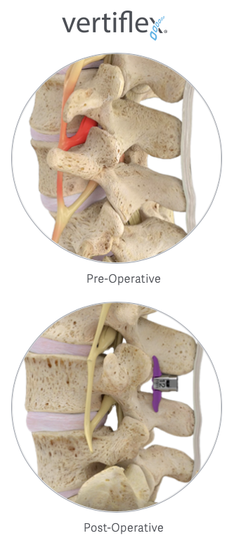 Vertiflex pre and post operative illustration