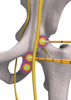 RFA Nerve Point Illustration