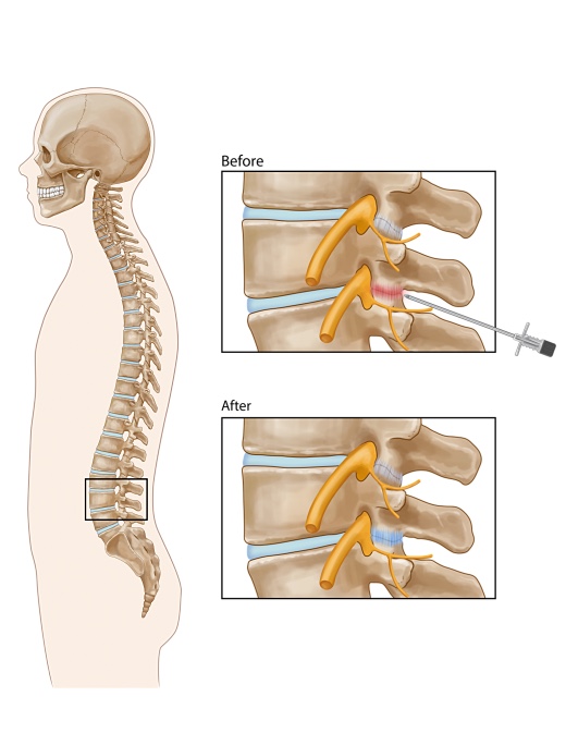 Insertion illustration for RFA Procedure