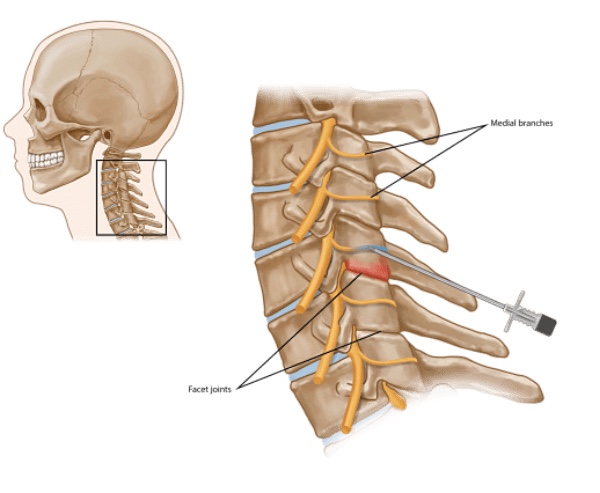 RFA Spine Image